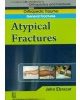 A Typical Fractures (Handbook In Orthopedics And Fractures Vol.4 - Orthopedic Trauma General Fractures)