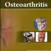 Osteoarthritis  (Handbooks In Orthopedics And Fractures Series, Vol. 87 -Common Orthopedic Problems)