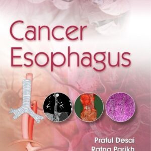 CANCER ESOPHAGUS (PB 2020) 