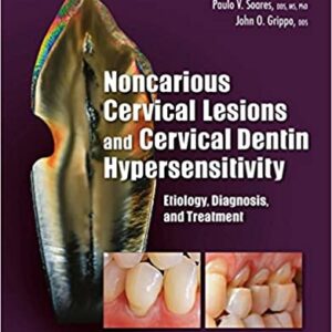 Noncarious Cervical Lesions And Cervical Dentin Hypersensitivity Etiology Diagnosis And Treatment Hb 2017