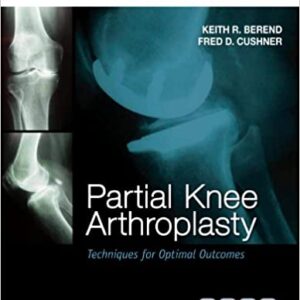Partial Knee Arthroplasty: Techniques For Optimal Outcomes