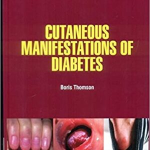 Cutaneous Manifestations Of Diabetes Hb 2021